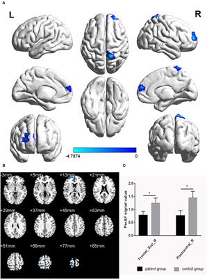 Altered Intrinsic Brain Activity in Patients With Toothache Using the Percent Amplitude of a Fluctuation Method: A Resting-State fMRI Study